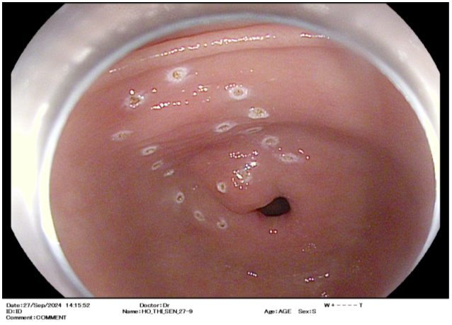 Bệnh viện 22-12 | Thêm nhiều bệnh nhân loại bỏ ung thư sớm đường tiêu hóa nhờ phương pháp ESD Bệnh viện 22-12 | Thêm nhiều bệnh nhân loại bỏ ung thư sớm đường tiêu hóa nhờ phương pháp ESD