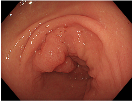 Bệnh viện 22-12 | Thêm nhiều bệnh nhân loại bỏ ung thư sớm đường tiêu hóa nhờ phương pháp ESD Bệnh viện 22-12 | Thêm nhiều bệnh nhân loại bỏ ung thư sớm đường tiêu hóa nhờ phương pháp ESD