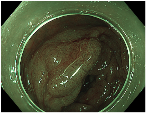 Bệnh viện 22-12 | Thêm nhiều bệnh nhân loại bỏ ung thư sớm đường tiêu hóa nhờ phương pháp ESD Bệnh viện 22-12 | Thêm nhiều bệnh nhân loại bỏ ung thư sớm đường tiêu hóa nhờ phương pháp ESD