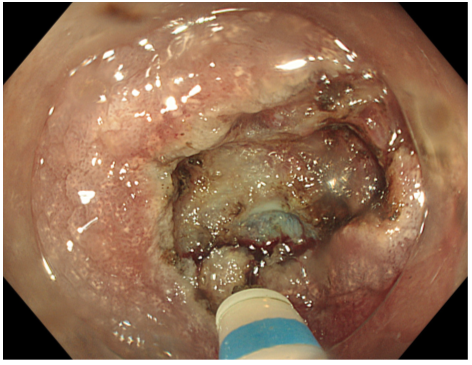 Bệnh viện 22-12 | Thêm nhiều bệnh nhân loại bỏ ung thư sớm đường tiêu hóa nhờ phương pháp ESD Bệnh viện 22-12 | Thêm nhiều bệnh nhân loại bỏ ung thư sớm đường tiêu hóa nhờ phương pháp ESD