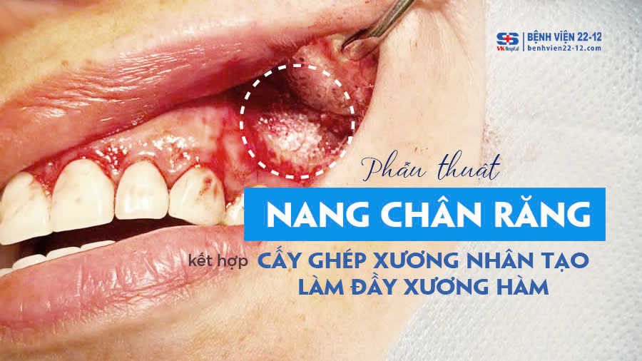 Bệnh viện 22-12 | Phẫu thuật nang chân răng Bệnh viện 22-12 | Phẫu thuật nang chân răng