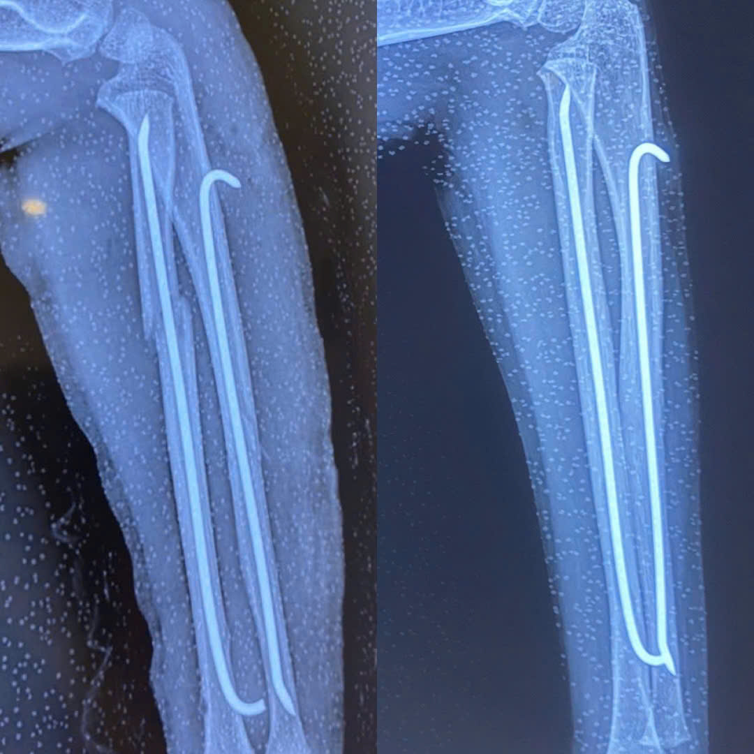 Bệnh viện 22-12 | Thời gian tháo phương tiện kết hợp xương Bệnh viện 22-12 | Thời gian tháo phương tiện kết hợp xương