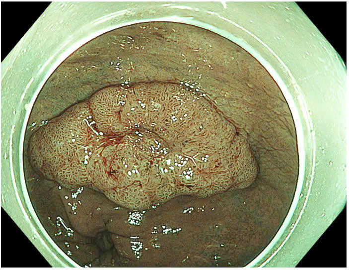 Bệnh viện 22-12 | Phá Bỏ Rào Cản Trong Điều Trị Ung Thư Sớm Bệnh viện 22-12 | Phá Bỏ Rào Cản Trong Điều Trị Ung Thư Sớm
