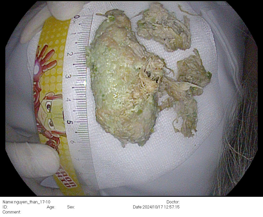 Bệnh viện 22-12 | Vào viện nội soi khẩn cấp vì miếng thịt mắc kẹt ở thực quản Bệnh viện 22-12 | Vào viện nội soi khẩn cấp vì miếng thịt mắc kẹt ở thực quản