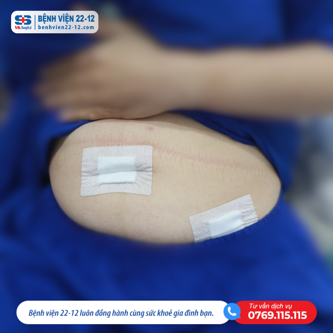 Bệnh viện 22-12 | Phẫu thuật nội soi cắt ruột thừa 2 vết mổ Bệnh viện 22-12 | Phẫu thuật nội soi cắt ruột thừa 2 vết mổ